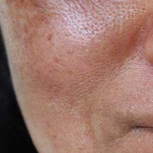 Hyperpigmentation